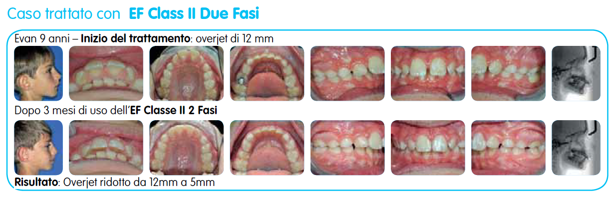 EF Classe II Due Fasi immagine testo