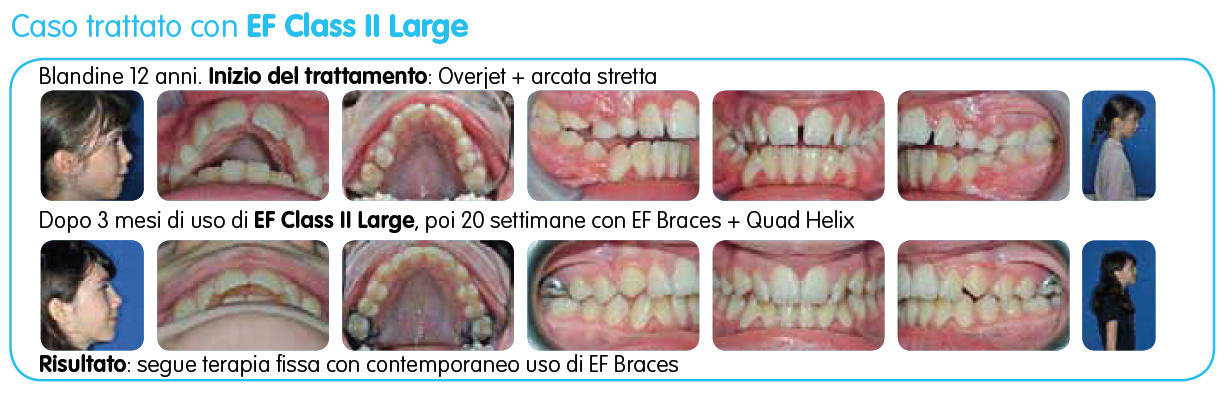 EF Classe II Large immagine testo